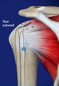 rotator-cuff-surgery - Seaside Surgery Center