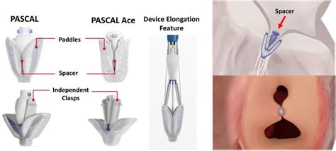 The Pascal System For Mitral And Tricuspid Regurgitation Treatment