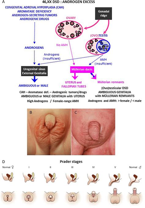Disorders Of Sex Development Of Adrenal Origin PMC