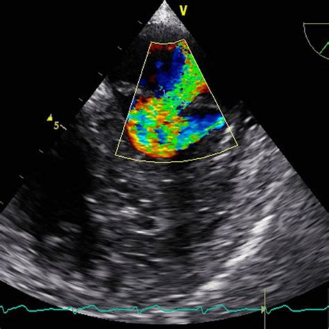 Mid Esophageal View At 50° Showing Moderate Mitral Valve Regurgitation