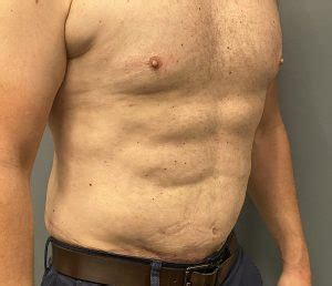 Male Tummy Tuck Ab Implants Oblique 2 Dr Barry Eppley Explore Plastic