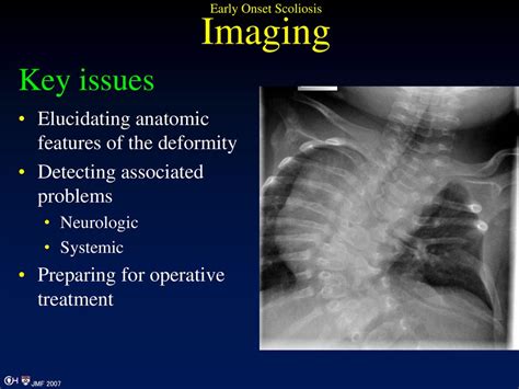 Imaging In Early Onset Scoliosis Ppt Download