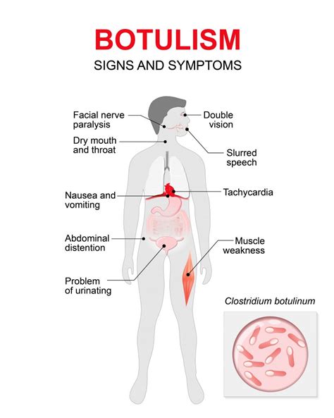 Clostridium Botulinum Diagram