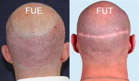 FUE vs FUT en el Trasplante de Cabello Diferencias Cruciales DHI Panamá