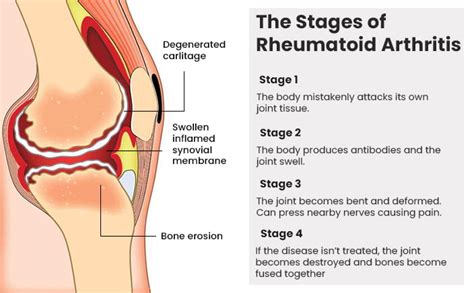 Arthritis Treatment In New Jersey Arthritis Specialists