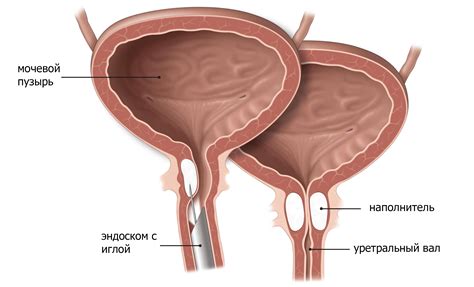 Narrowing of the urethra in Tashkent
