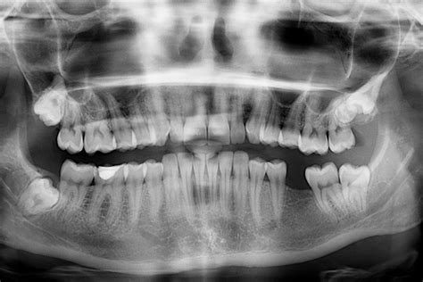 Extracci N Muelas De Juicio Preguntas Frecuentes Nart Cl Nica Dental