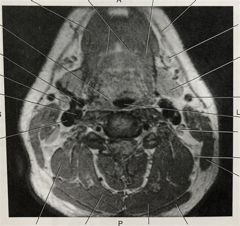 Axial T1 Mri Neck Diagram Quizlet