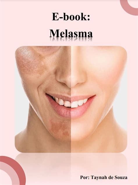 Guia do melasma Tudo o que você precisa saber para tratar Taynah de