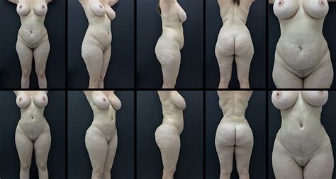 SciELO Brasil Outras tendências na abdominoplastia novo desenho e