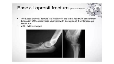 Radial Head Fracture Ppt