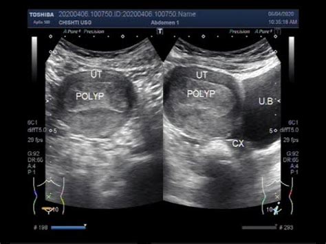 Ultrasound Video showing Endometrial polyp. - YouTube