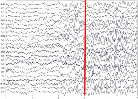 The scalp EEG of patient A. The red bar marks the onset of a seizure ...