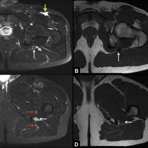 E Case 2 A 28 Year Old Male A And B Axial T2 Weighted Fat Download Scientific Diagram