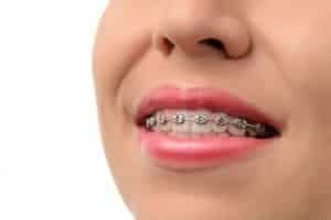 Benefits Of Conventional Braces Vs Lingual Braces Vs Invisalign Smile