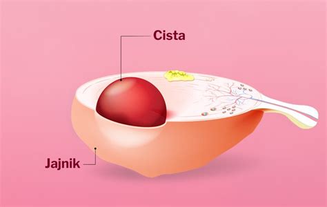 Sindrom Policisti Nih Jajnika Ili Cista Na Jajnicima Znate Li Razliku