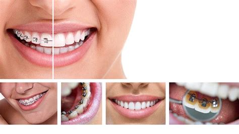 Lingual Braces Vs Invisalign Invisalign London