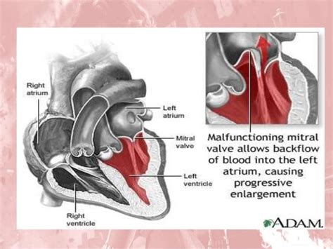 Mitral Valve Prolapse