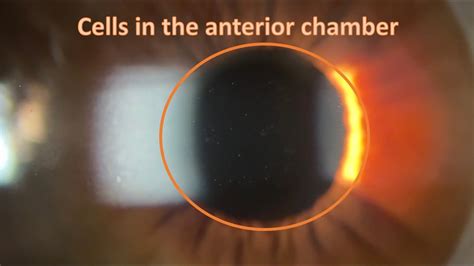 Cells In The Anterior Chamber Youtube