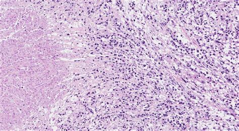 Adenocarcinoma of the stomach | Atlas of Pathology