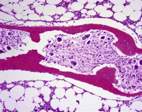 Patho Bone And Mineral Disorders Flashcards Quizlet