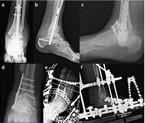 Operative Management Of Charcot Neuropathy Of The Foot And Ankle A