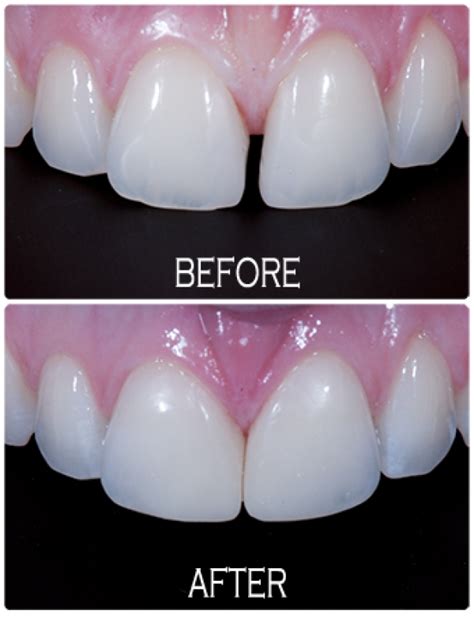 Tooth Coloured Resins | Kaleen Dental Care & Facial Aesthetics