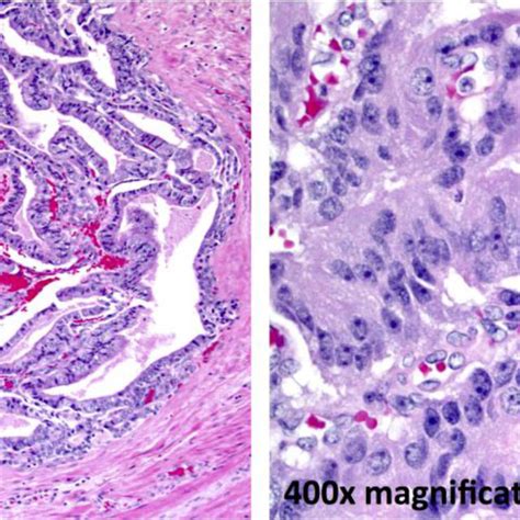 Ductal Adenocarcinoma Component In This Case Approximately 65 Of The Download Scientific