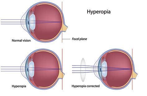 Hyperopia(farsightedness): Symptoms, Causes & Treatment » How To Relief