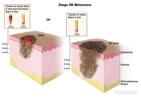 Melanoma Treatment (PDQ®) - NCI
