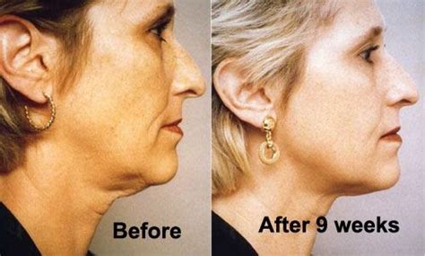 Neck Tightening Exercises Before And After Exercise Poster