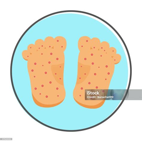 Hand Foot And Mouth Disease Symptoms Stock Illustration - Download ...