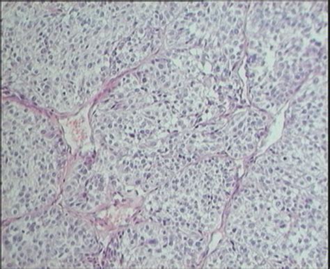 Soft Tissues Clear Cell Sarcoma