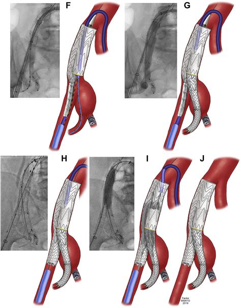 Outcomes After Standalone Use Of Gore Excluder Iliac Branch