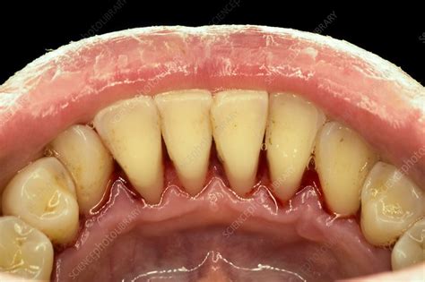 Teeth After Ultrasonic Cleaning Stock Image C0299600 Science Photo Library