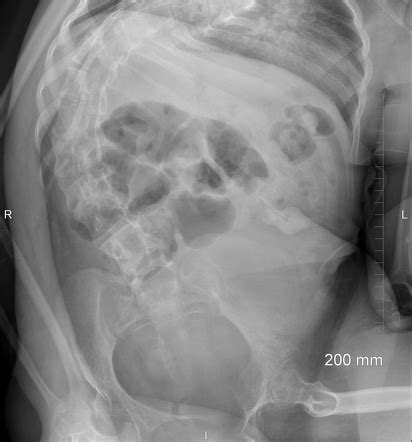 Over The Scope Clip Otsc Radiology Case Radiopaedia Org