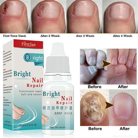 10ml Nail Fungus Treatment Cream Onychomycosis Paronychia Anti Fungal ...