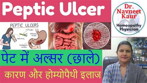 Peptic Ulcer पेट में अल्सर छाले Cause Symptoms And Homeopathy Treatment Youtube