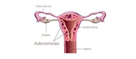 Adenomiose Conhe A Os Sintomas Dr Gustavo Andr