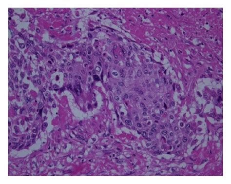 Microscopic View Of The Tumor Squamous Cell Carcinoma Hematoxylin And Download Scientific