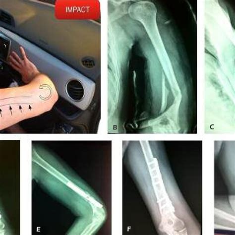 A, Illustration of the trauma mechanism of spiral humerus fracture with ...