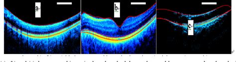 Figure From Doppler Optical Coherence Tomography For Choroidal