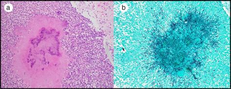 A Hematoxylin And Eosin Stained Slide Showing A Cluster Of