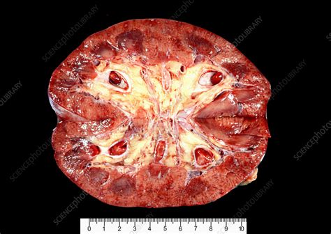 Acute Pyelonephritis Stock Image C Science Photo Library