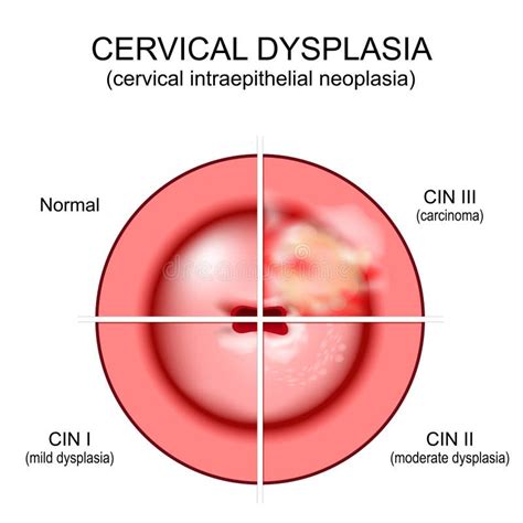 Cervical Cancer Carcinoma Of Cervix Stock Vector Illustration Of