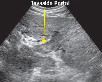 Ultrasonido Lesiones Focales Del H Gado Gastro M Rida