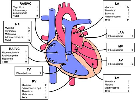 Types Of Heart Tumors