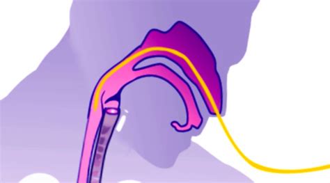 Enteral Tube Feeding Flashcards Quizlet