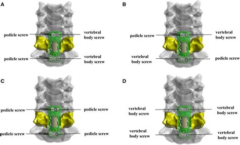 Frontiers Biomechanical Evaluation Of A Novel Anterior Transpedicular