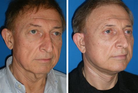 Cosmetic Surgery For Men Gallery Richmond Va Cosmetic Facial Surgery